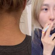 '흡연 논란' 옥주현, 이번엔 목에 장침 꽂아 "흔치 않은 일"