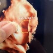 박수홍♥김다예, 딸 초음파 공개 "다리 길고 쌍꺼풀 보여"